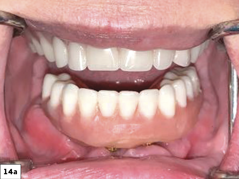 The completed Locator Fixed Prosthesis exhibits excellent stability during function (a). The completed Locator Fixed Prosthesis in occlusion (b). Panoramic X-ray of the seated mandibular prosthesis (c). The patient expressed her intention to address the maxillary arch at a later date.