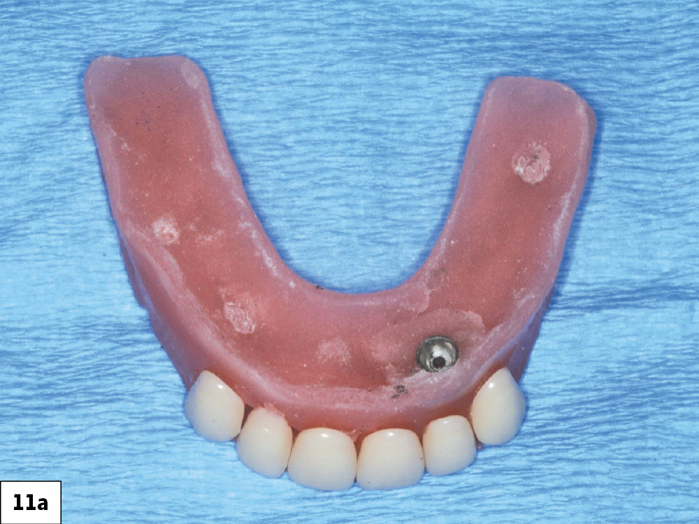 A wax rim was tried in and adjusted to determine the appropriate vertical dimension. I then threaded multiunit abutment (MUA) healing caps over the MUAs for the patient’s comfort and added retention of the transitional complete denture.