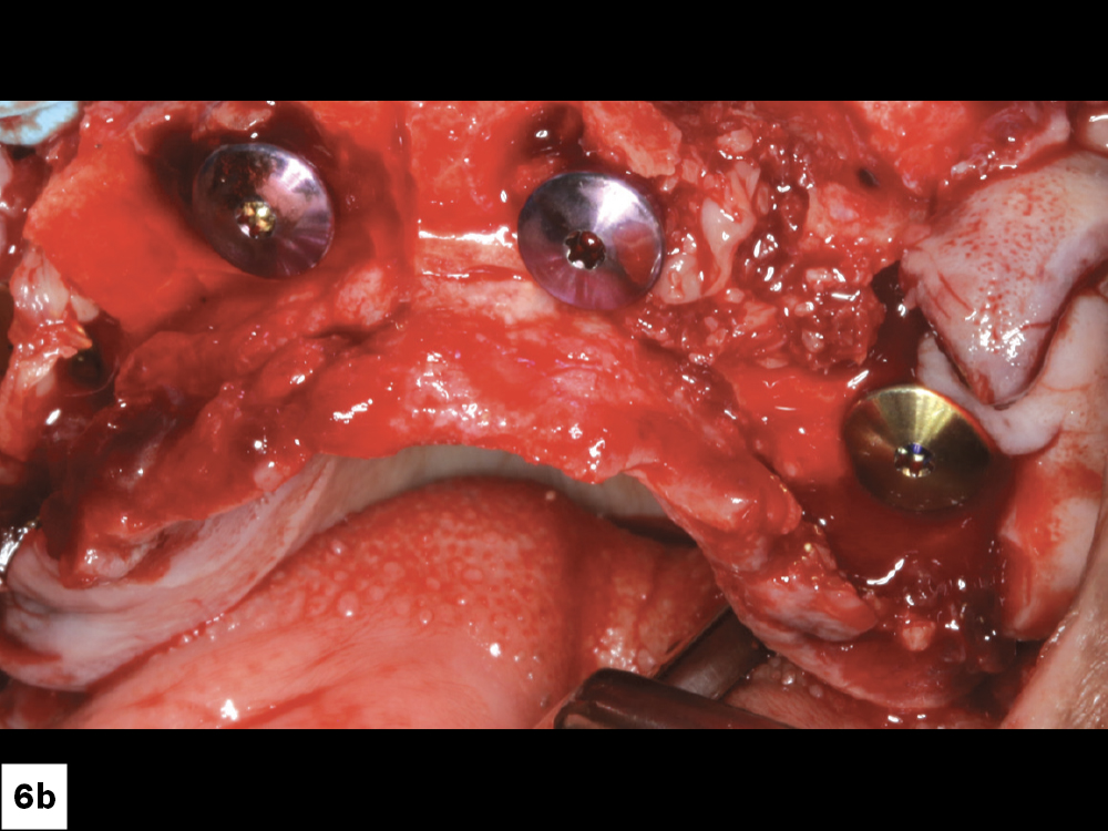 I used Newport Biologics™ allograft particulate (Glidewell Direct; Irvine, Calif.) to fill in facial defects and socket sites to prevent the invagination of epithelium.