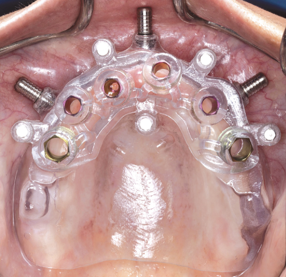 Tissue-supported guides are held in place by mucosa and fixation pains. No reflection of soft tissue is necessary when using these types of guides.