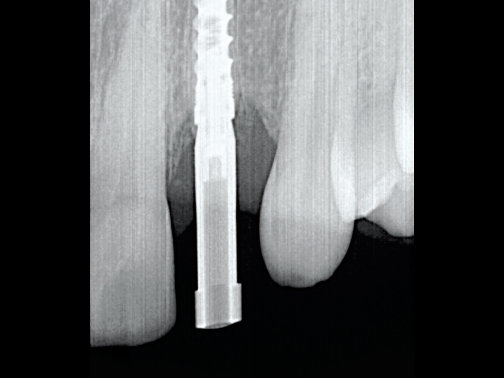 I took a vertical bite wing to verify complete seating of the scan body. Once I confirmed no hard or soft tissue was interfering, I knew my scan would capture an accurate record for the lab.