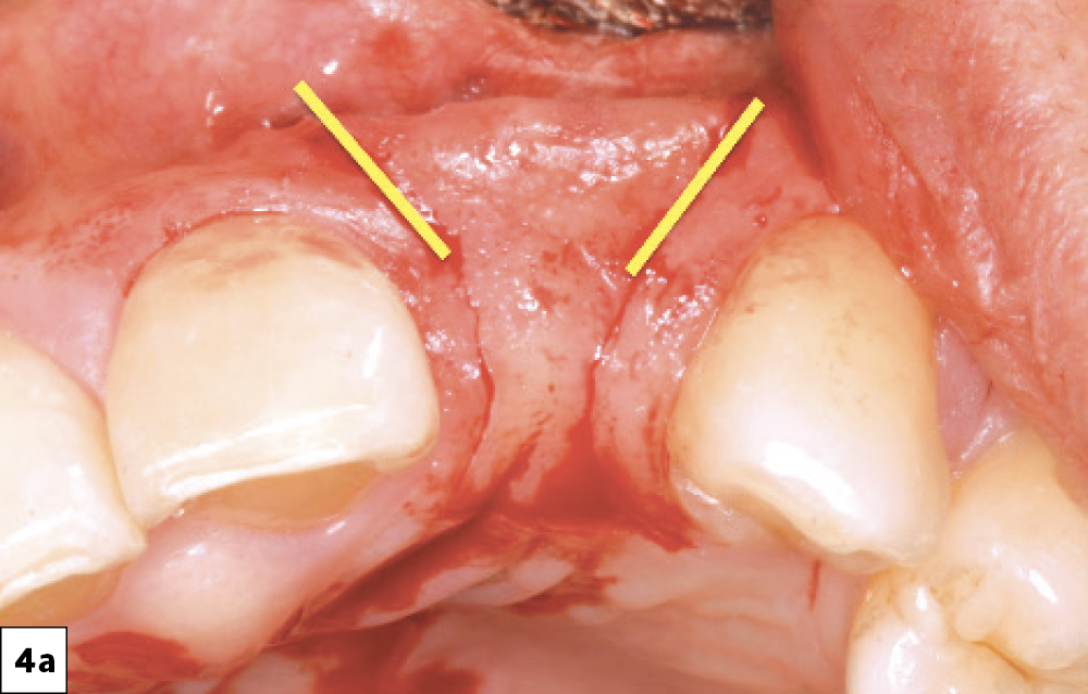 Papilla-sparing incision leaving about 1 mm of papillary tissue adjacent to the natural tooth.