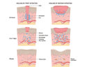 Management of Incision Line Opening for Better Healing