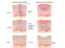 Management of Incision Line Opening for Better Healing
