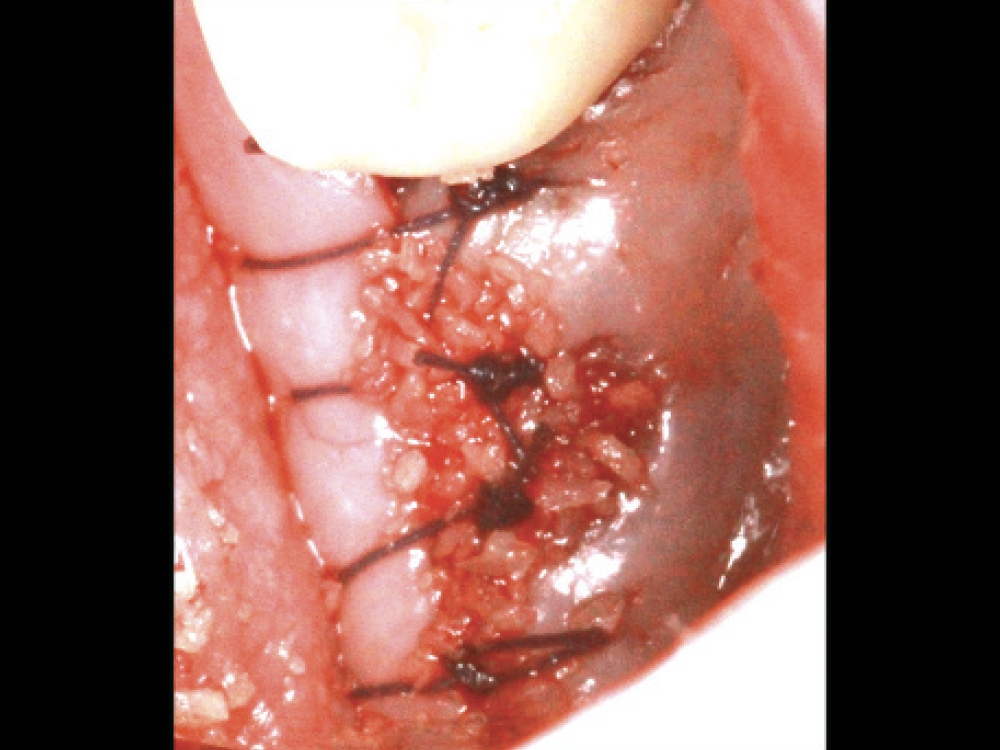 Bone particles within incision line which may lead to delayed healing.