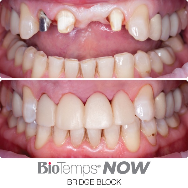 BioTemps Now Bridge Block