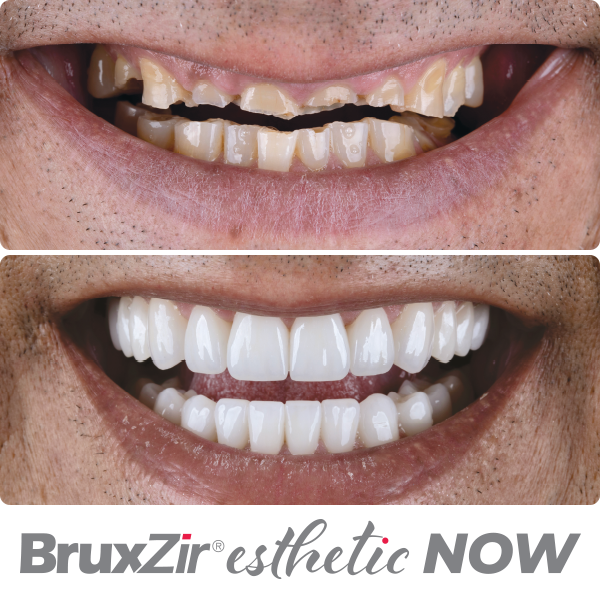 BruxZir Esthetic Now