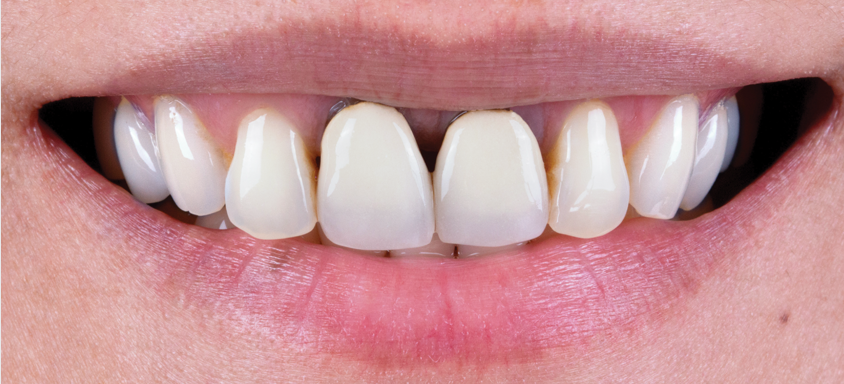 BruxZir Esthetic NOW - Anterior (Before)