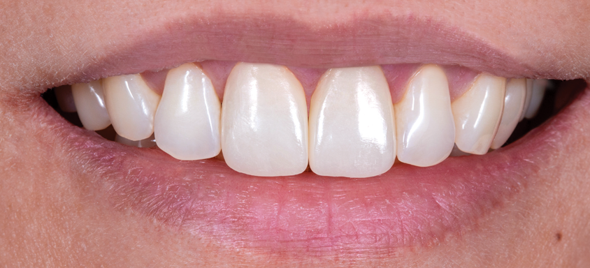 BruxZir Esthetic NOW - Anterior (After)