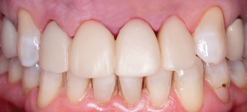 BioTemps® NOW Bridge Block (After)