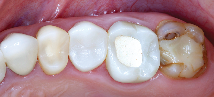 BioTemps® NOW (Before)