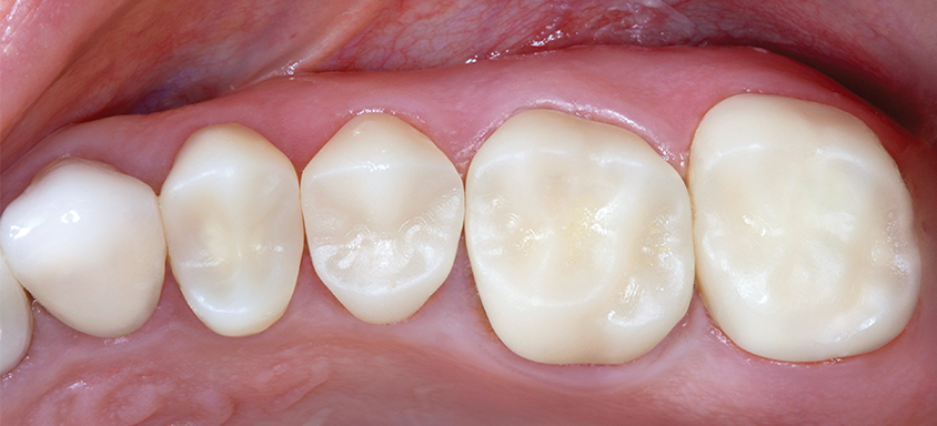 BioTemps® NOW (After)