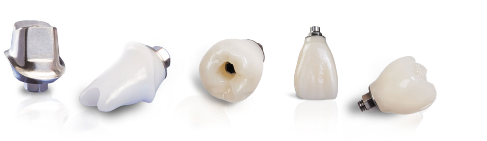 Custom Abutments and Implant Crowns
