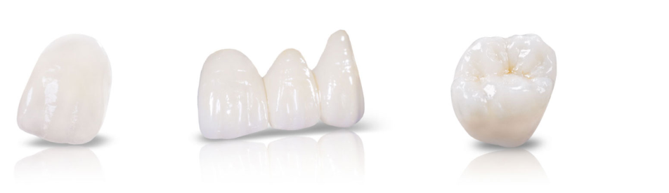 IPS e.max Restorations