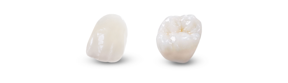 IPS e.max Restorations