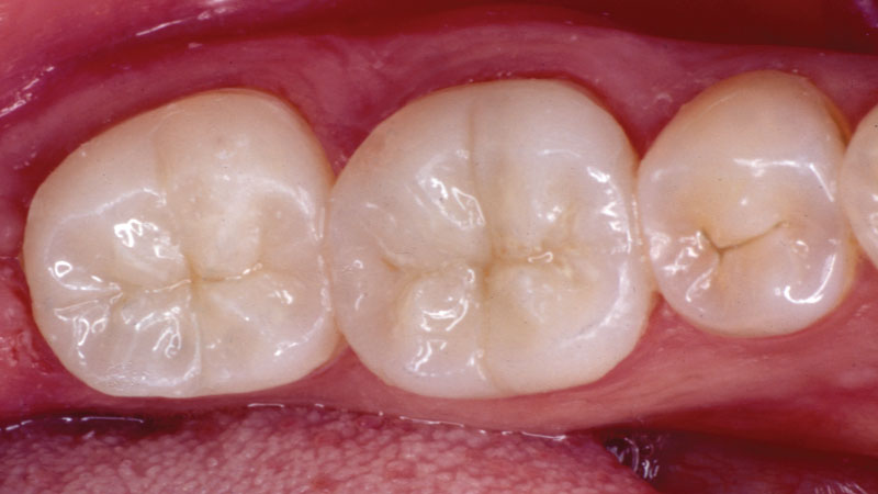Case 2 After - Composite was selected for a durable restorative solution