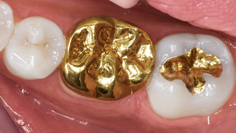 Tooth restored with CAD/CAM full-cast gold crown