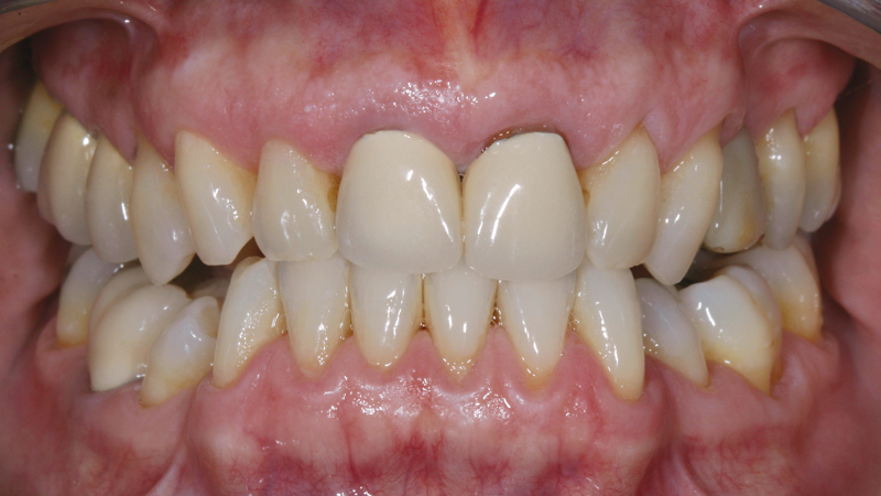 This patient felt that his existing PFMs did not appear natural.