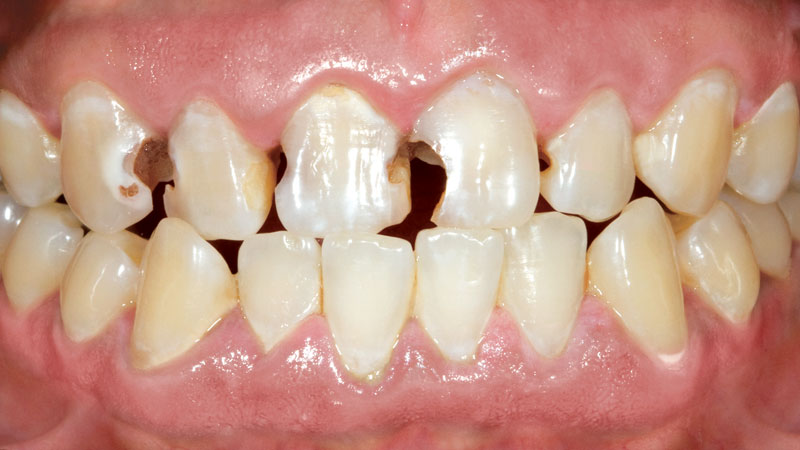 patient with sever teeth decay