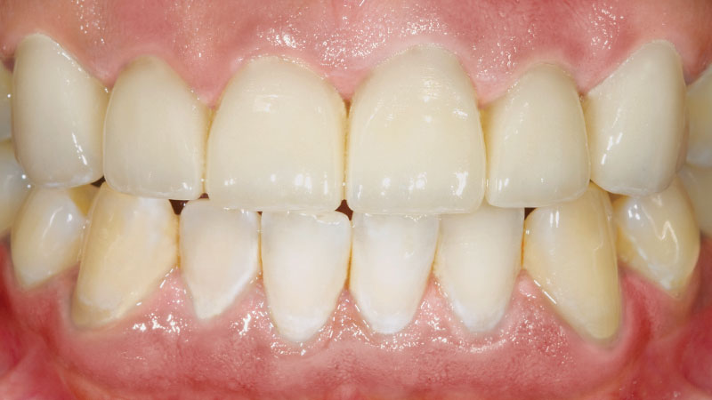 IPS e.max crowns were placed on teeth #6-11