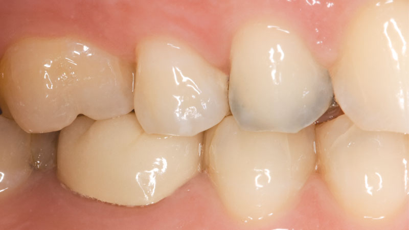 patient's teeth with amalgam and recurrent decay on tooth #5