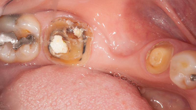female patient with existing PFM bridge on teeth #29-31