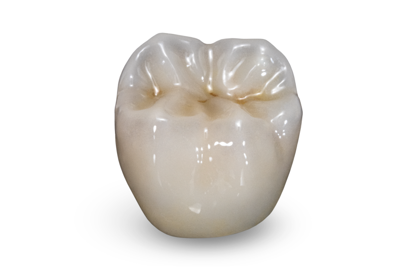 Glidewell BruxZir zircone antérieure