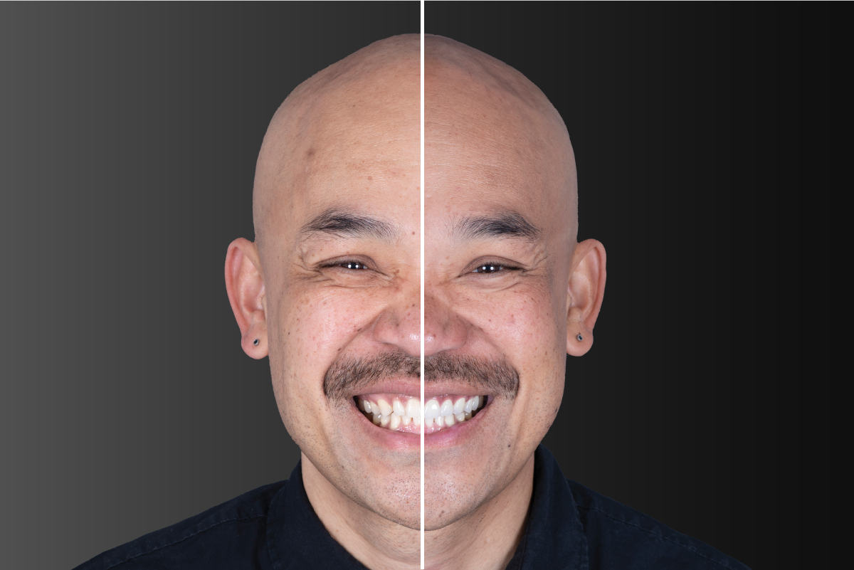 Rith | Teeth Restored: #4-13 | Restoration Types: Veneers