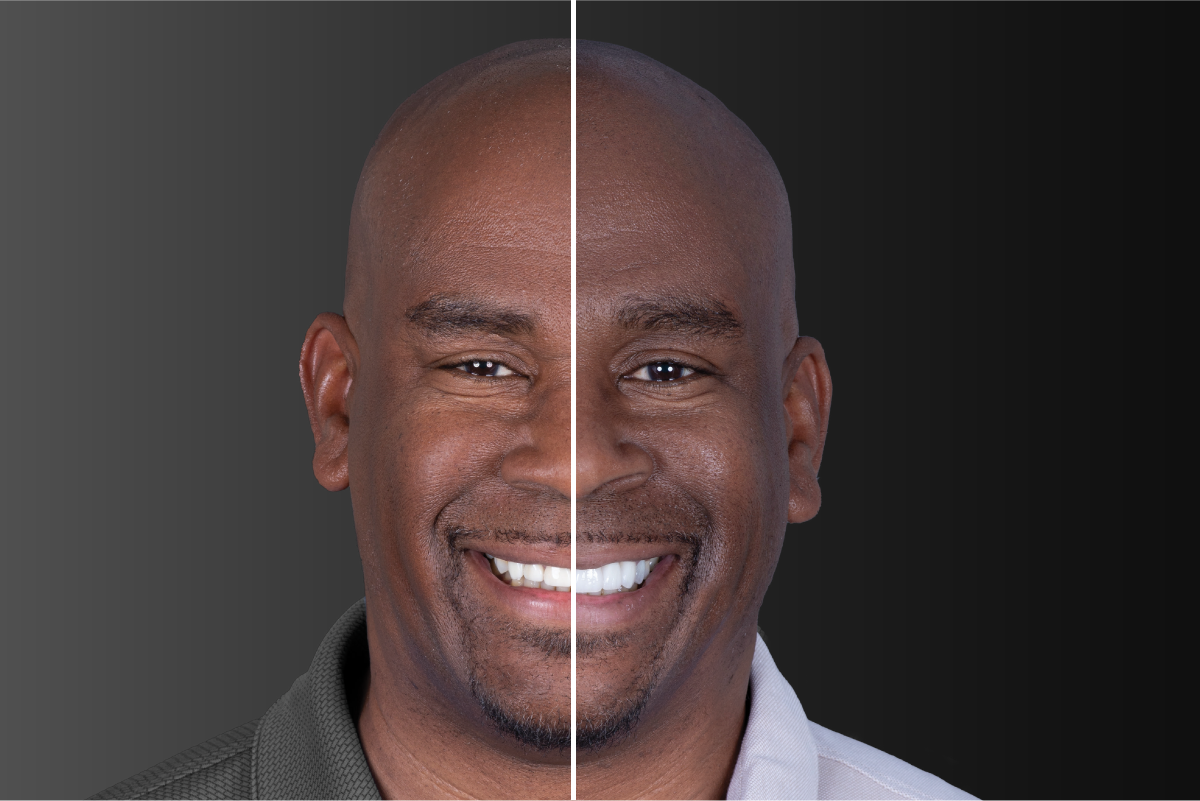 Oran | Teeth Restored: #6-12 | Restoration Types: Crowns & Bridge