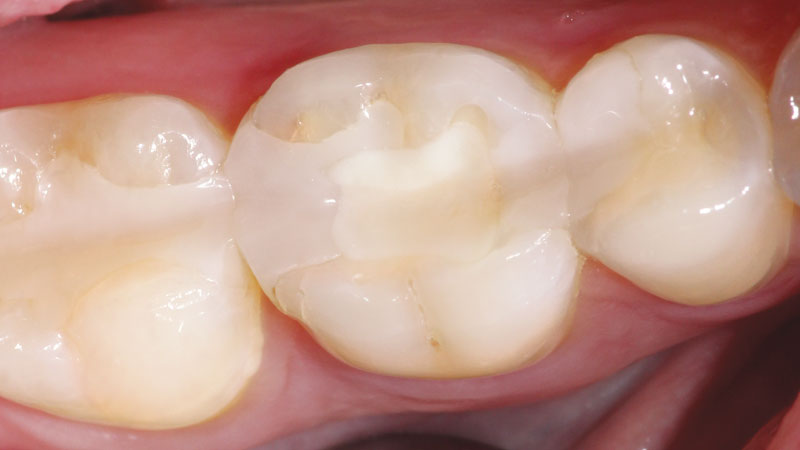 patient's failing composite restoration