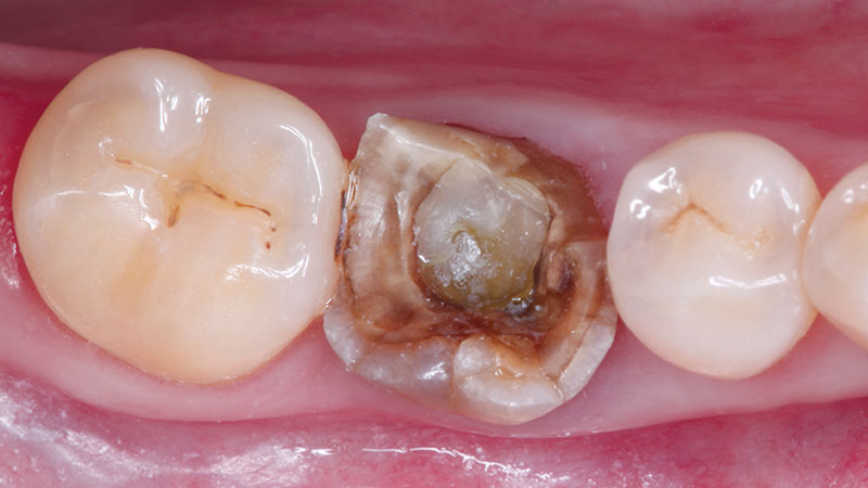 fractured molar that had gone untreated for some time