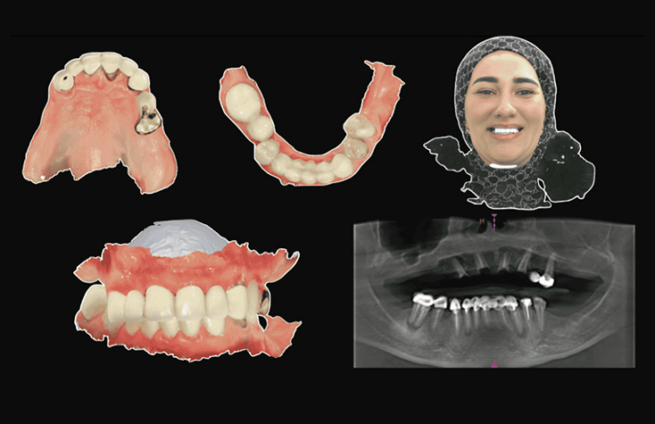 Preliminary diagnostic records including facial scan, intraoral scans of the maxilla, mandible and occlusion.