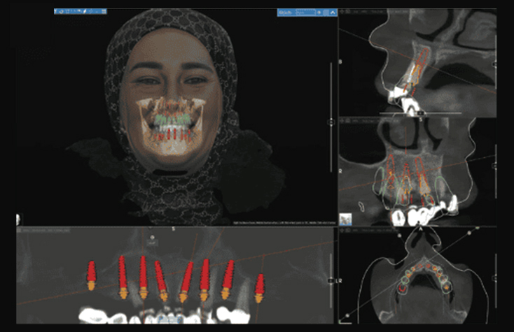 Comprehensive, top-down treatment planning to accommodate an FP1 prosthetic design performed by the Glidewell Digital Treatment Planning (DTP) team.