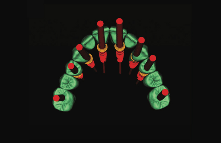 Occlusal view of the planned digital prosthetic design