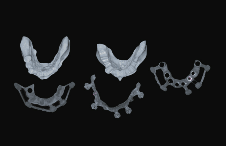 Stackable surgical guides and diagnostic models fabricated for guided surgery (GlidePRO™ Stackable Surgical Guide System).