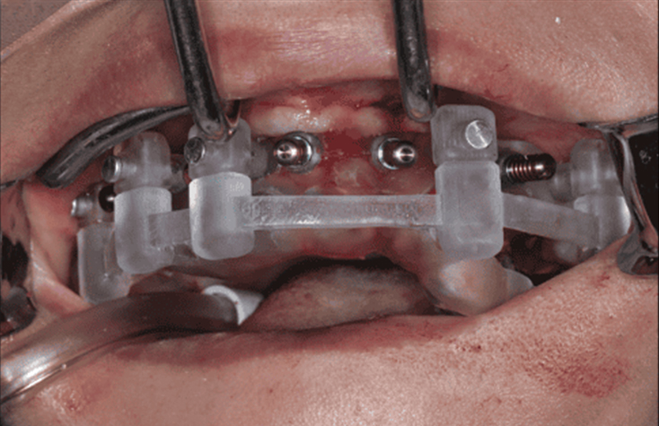 Seating and pinning of the bone-supported foundation guide using anchor pins.