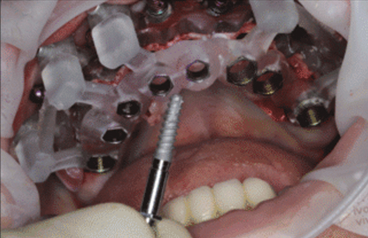 Osteotomy preparation and placement of mount-supported implants through the osteotomy guide using the Glidewell HT™ Guided Surgical Kit and implant system.
