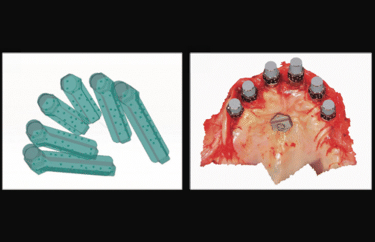 Digital rendering of the intraoral photogrammetry and soft-tissue cap scan body capture. 