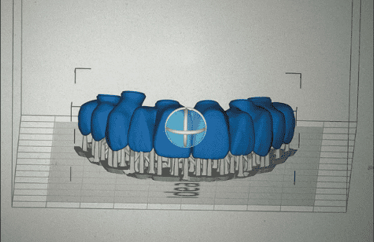 Nesting of the same-day 3D-printed provisional design prepared for in-office fabrication.