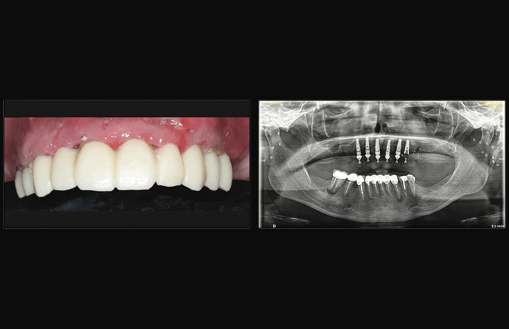 Two-week postop intraoral and extraoral photographs and panoramic radiograph.