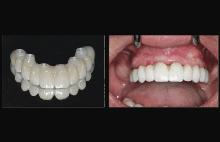 Delivery of the final Glidewell BruxZir® Esthetic restoration.
