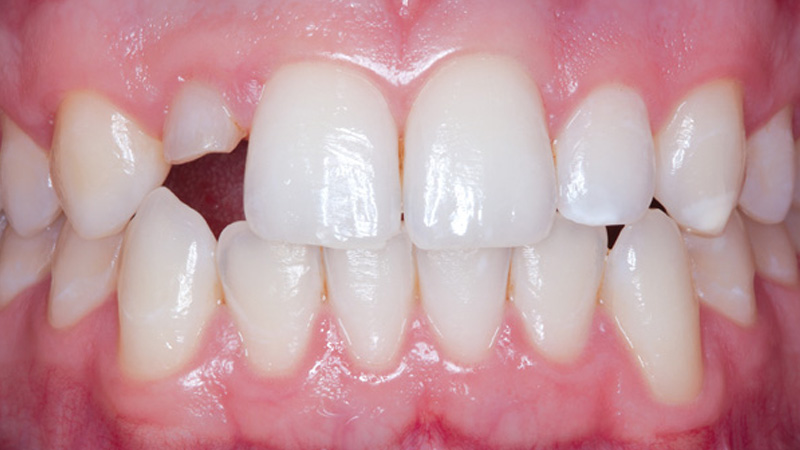 Patient's retained primary lateral incisor
