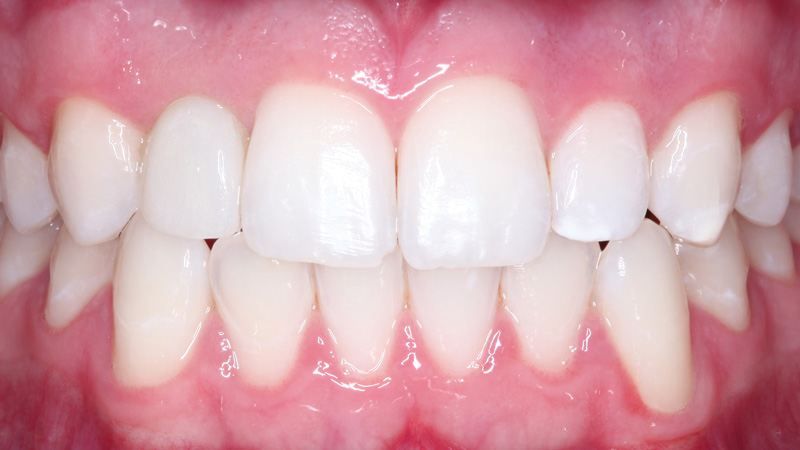 Four months later, restoration is delivered with ease with a screw-retained crown