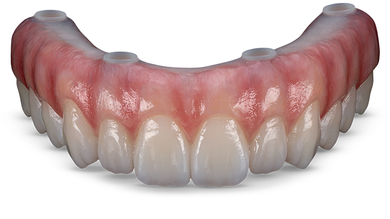 BruxZir® Esthetic Implant Prosthesis