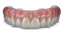 Glidewell Implant Solutions BruxZir Full-Arch Implant Prosthesis