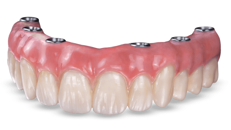 BruxZir Full-Arch Implant Prosthesis