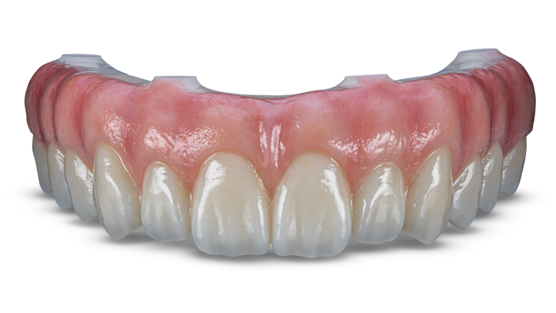 BruxZir Full-Arch Implant Prosthesis
