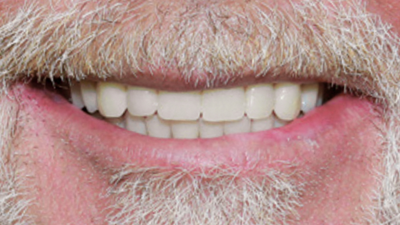 patient with Locator CAD/CAM-milled bar overdenture