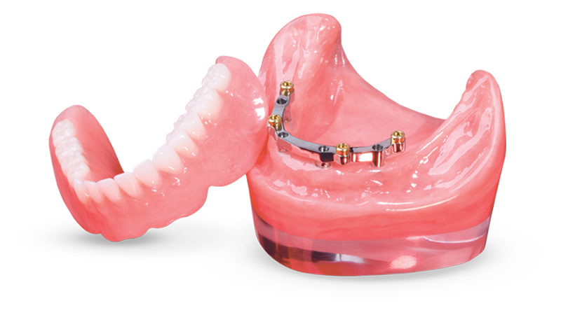 Locator CAD/CAM-Milled Bar Overdenture Signature Image