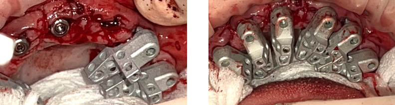 Placement of Individual Scan Bodies